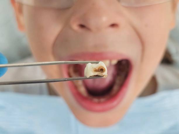 Best Emergency Wisdom Teeth Removal in Schlusser, PA